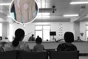 光疗治疗白癜风危害