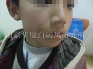 【NO.59990病例】10岁孩子选择南京华厦治好了唇部白斑